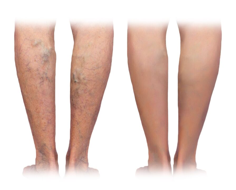 pernas com varizes antes e depois de usar o creme Veniselle